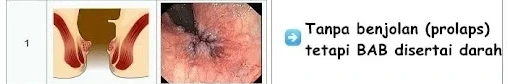 wasir,ambeien