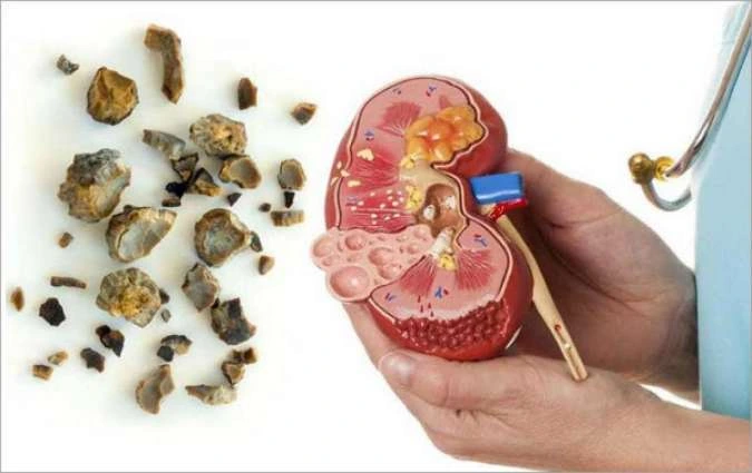 obat batu ginjal,obat batu ampedu,obat kencing batu,obat batu ginjal ampuh