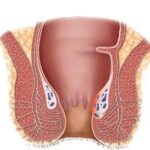 Obat Ambeien,obat Ambeien ampuh,ambefree