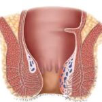 Obat Ambeien,obat Ambeien ampuh,ambefree