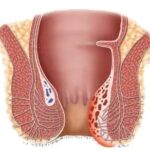 Obat Ambeien,obat Ambeien ampuh,ambefree