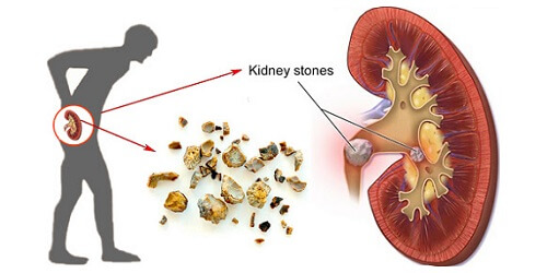 obat batu ginjal,obat batu ampedu,obat kencing batu,obat batu ginjal ampuh